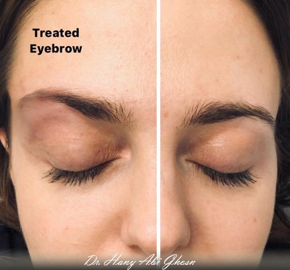 Finally, a noknife eye lift that actually works! Dr Hany Abi Ghosn