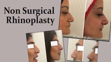 The “liquid nose job” aka  “10 min nose job”. Another exclusive procedure that spares you hassle of surgeries.
