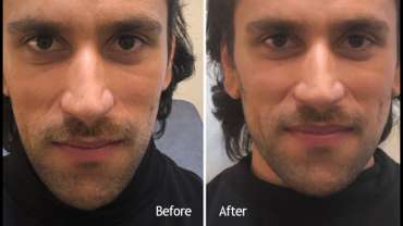 Male Face Sculpt – A “Signature” Treatment by Dr. Hany Abi Ghosn winning Best Medical Practice – Europe 2018
